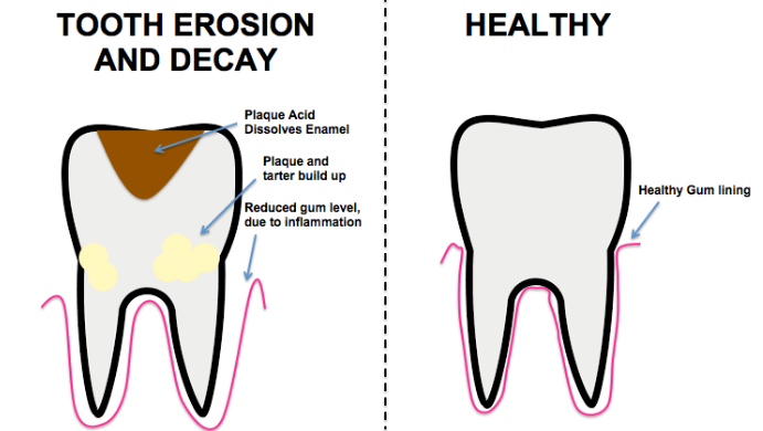 Image Describing Tooth Decay