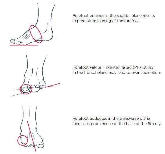 Vasyli Hoke Supination Control Orthotic Control Pes Cavus Foot Type