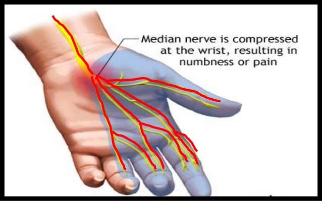 carpal-tunnel-wrist-brace-carpal-tunnel-wrist-splints